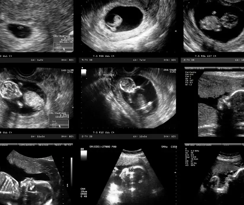 Badania prenatalne w 3. miesiącu ciąży - blog helloskarbie.pl