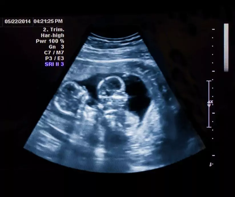 Jak rodzą się bliźniaki? Poród naturalny czy cesarskie cięcie? - blog helloskarbie.pl